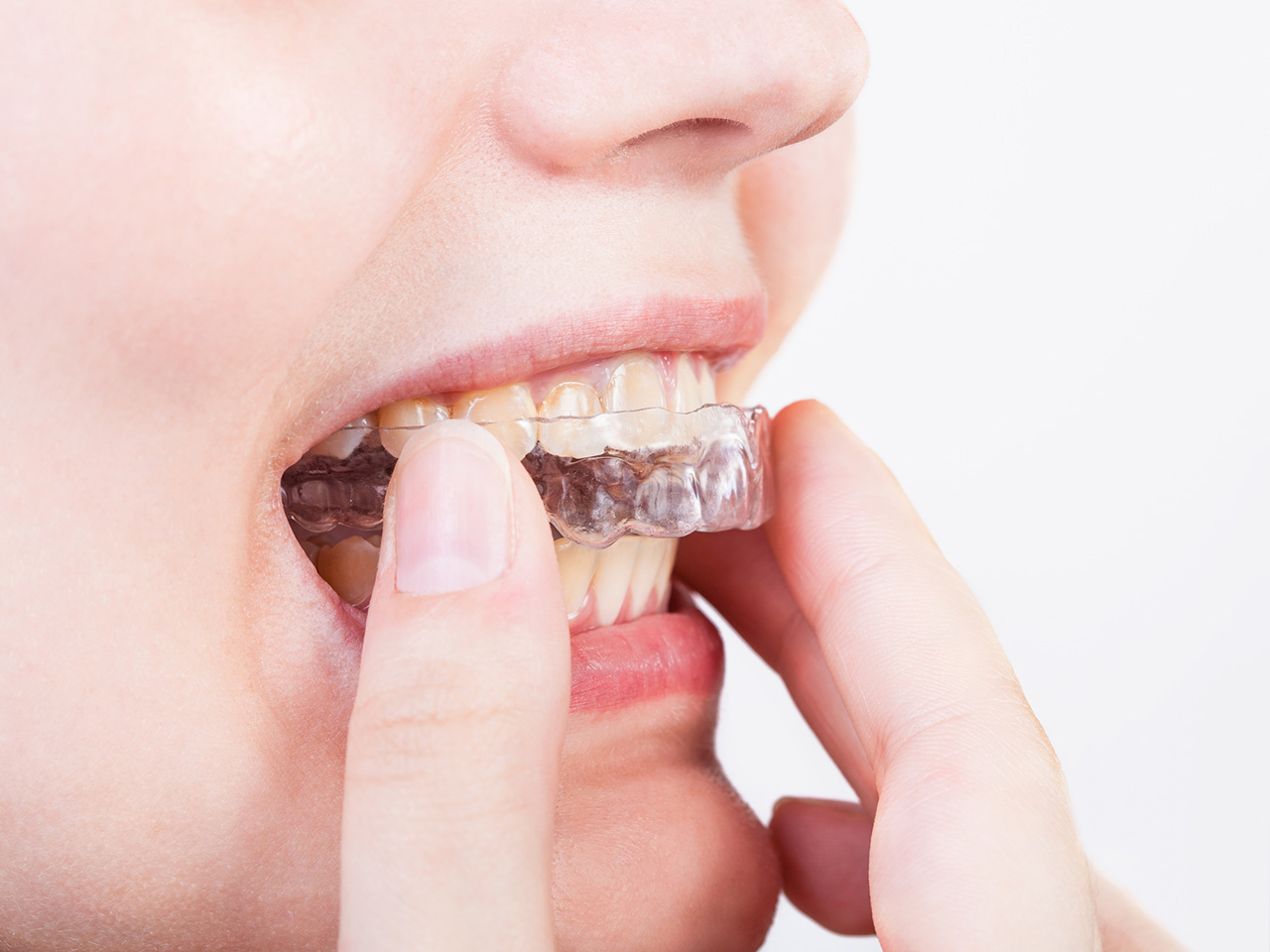 What Are Bite Guards Braces? Pain Relief Solutions