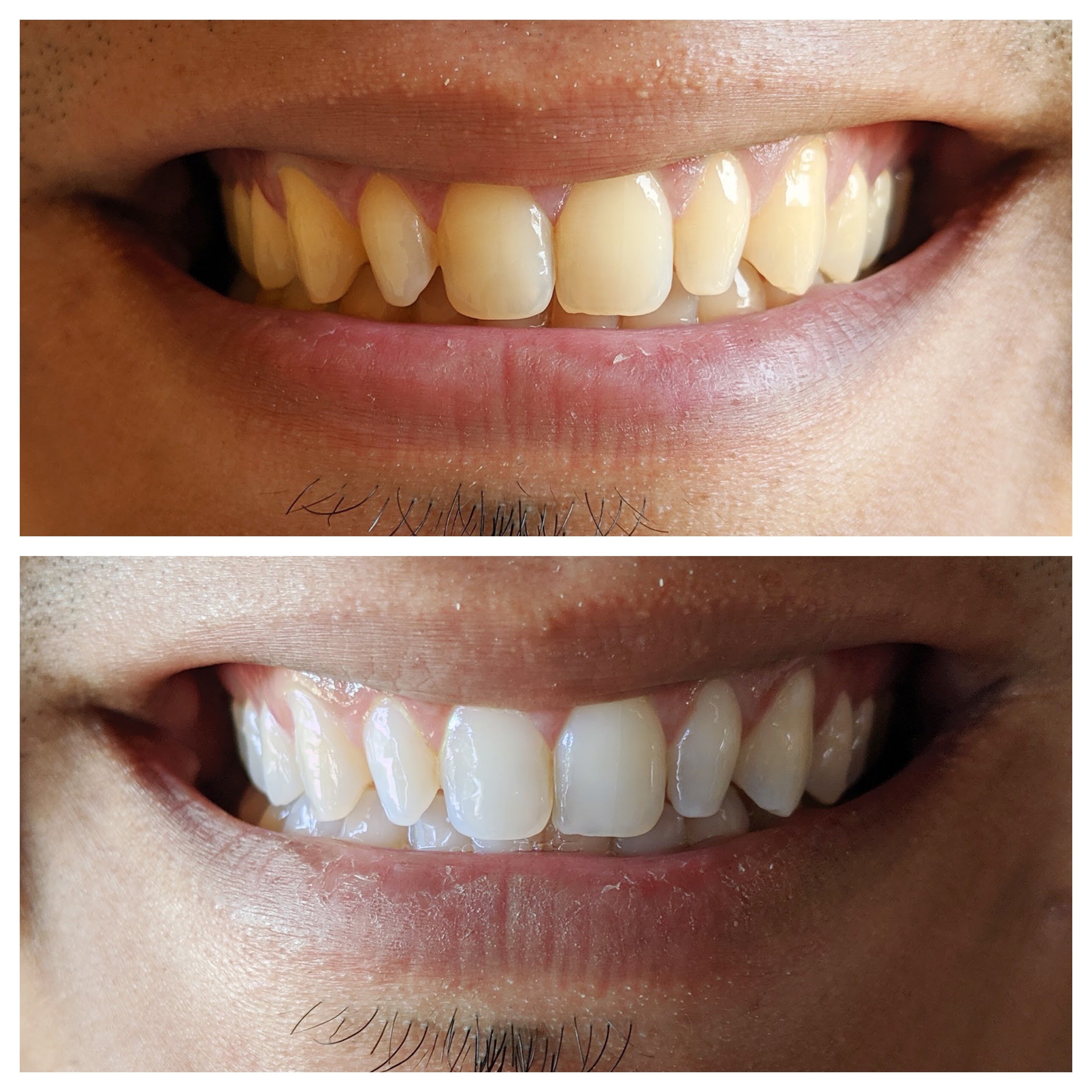 What Are Colgate Whitening Strips? Instant Smile Boost