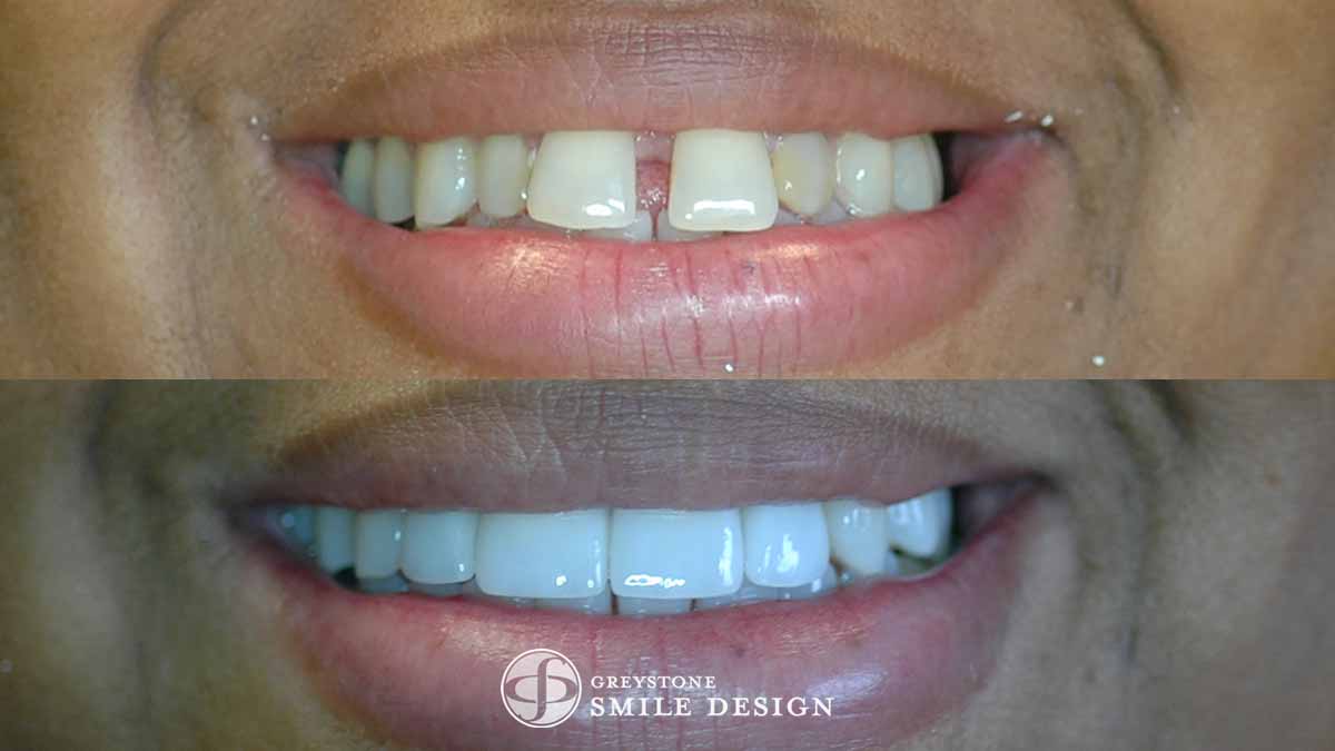 What Are Porcelain Teeth Veneers? Smile Transformation