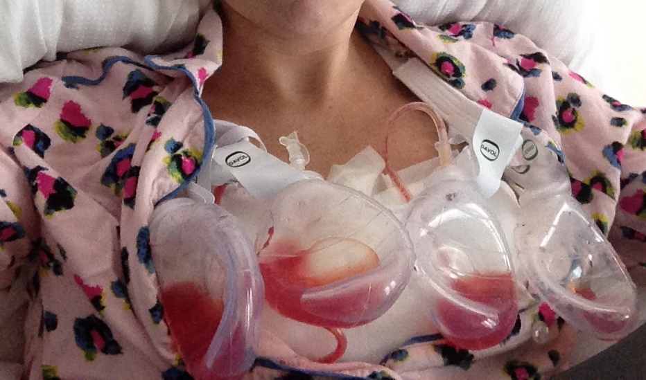 What Are Surgical Drains After Mastectomy? Expert Guidance