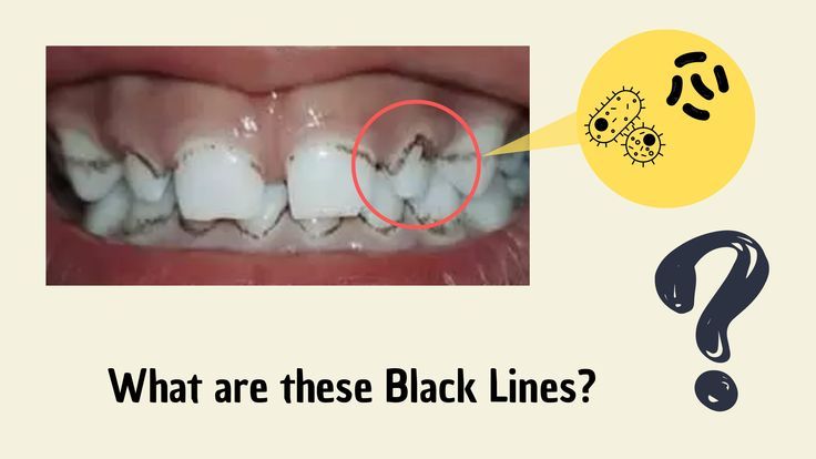 What Are These Black Lines On Teeth And How To Remove Them What Are These Black Lines On Teeth And How To Remove Them