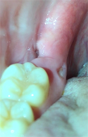What Causes Bone Fragments In Gums? Expert Removal
