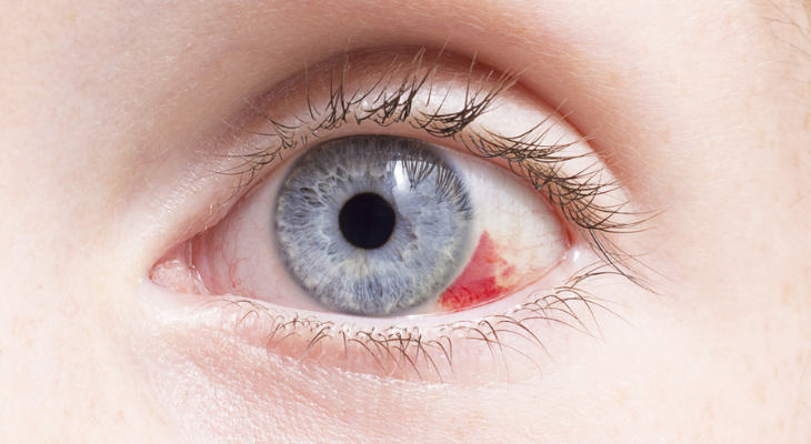 What Causes Broken Blood Vessel? Fix Your Face