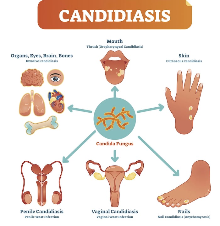 What Causes Candidiasis? Effective Crema Solutions What Causes Candidiasis? Effective Crema Solutions
