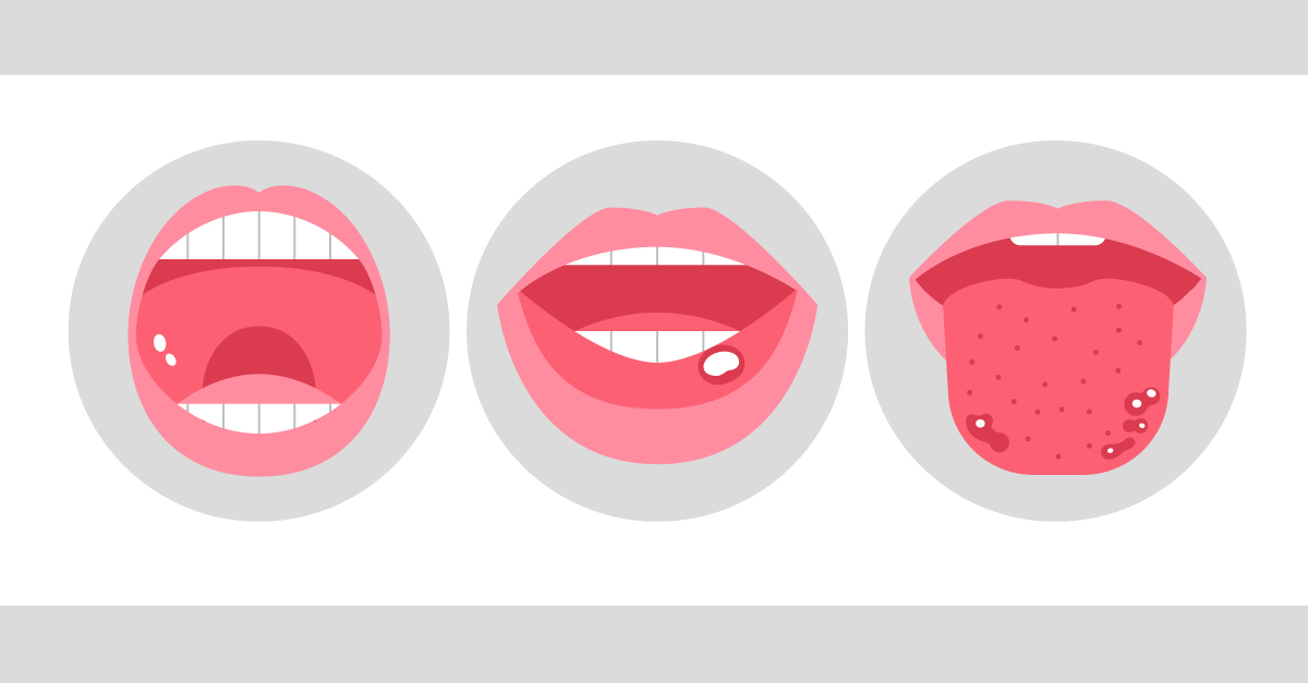 What Causes Canker Sores During Pregnancy? Relief Guide