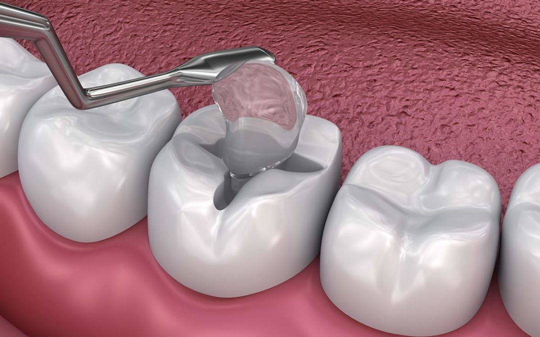 What Causes Cavity Fillings To Fall Out? Fixing Loose Fillings