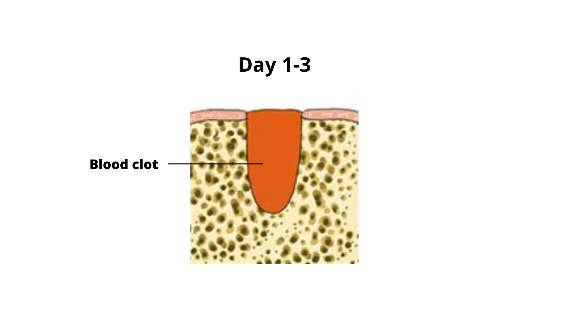 What Causes Clot After Tooth Extraction? Fast Healing Tips
