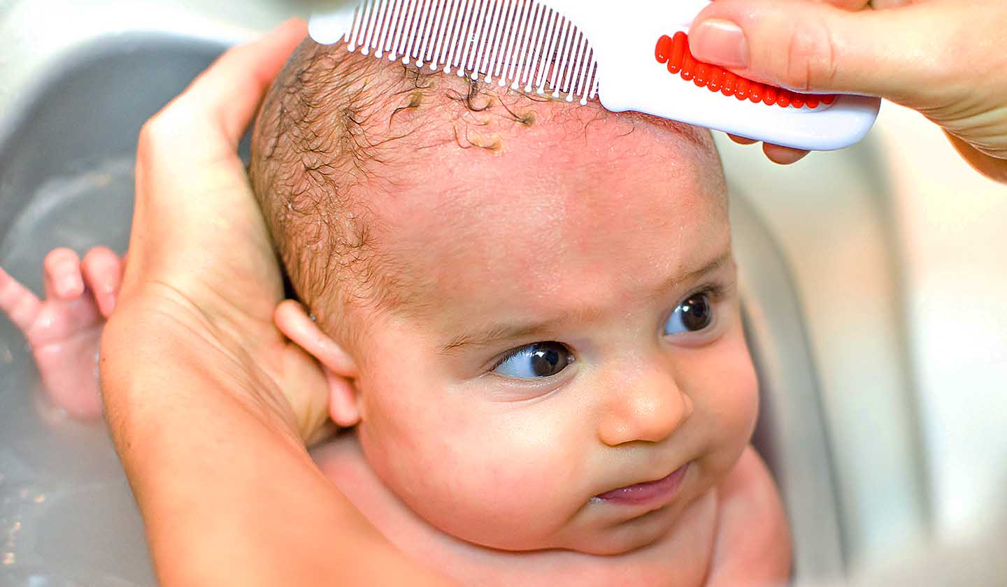 What Causes Crosta Láctea? Easy Solutions