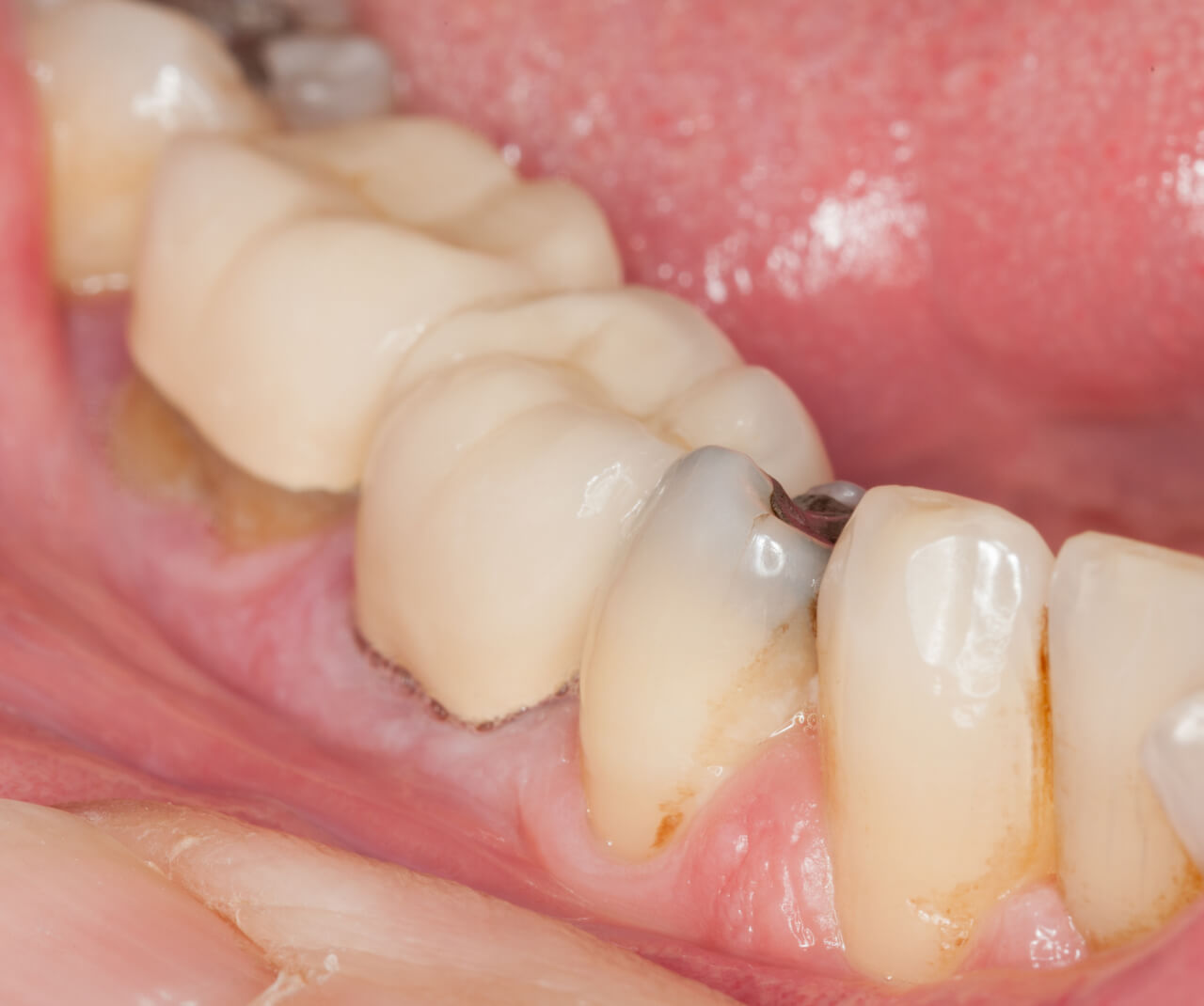 What Causes Dark Spot On Gumline? Easy Removal Tips