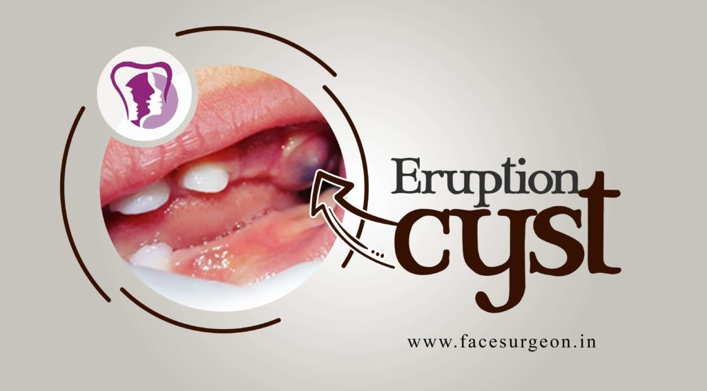 What Causes Dental Eruption Cyst? Pain Relief Guide
