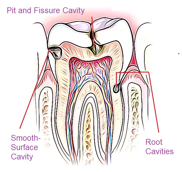 What Causes Fillings Pain? Find Relief