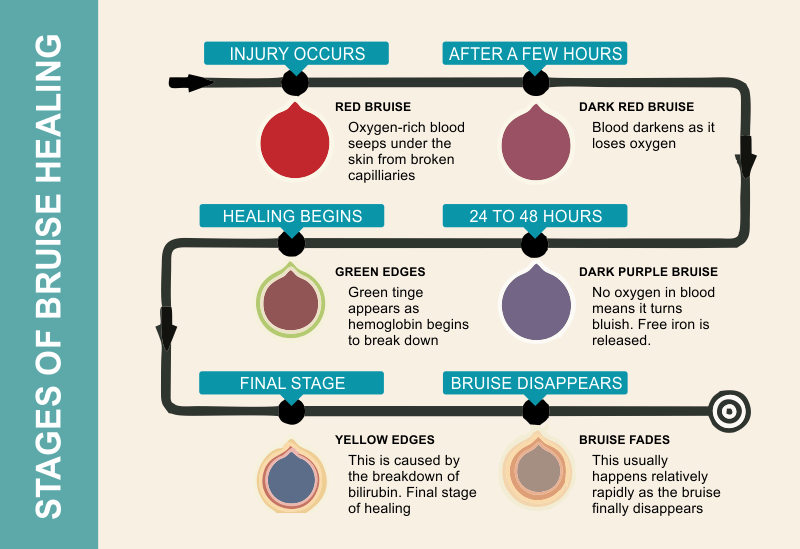 What Causes Gum Bruise Above Tooth? Easy Healing Tips