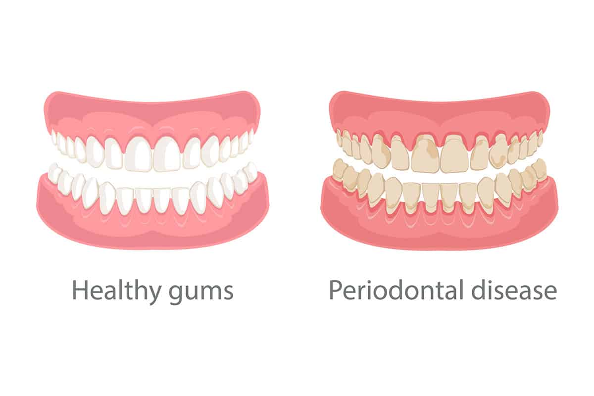What Causes Gum Disease? Expert Dentist Solutions