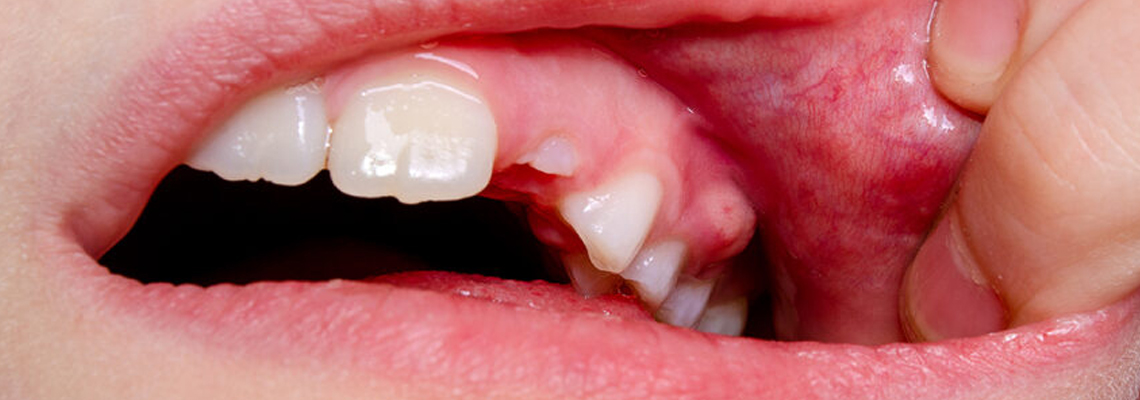What Causes Kids Tooth Abscess? Easy Fix Guide