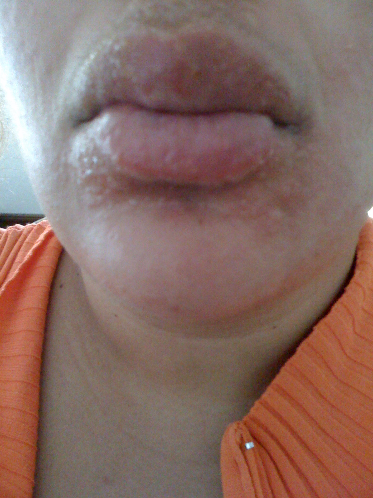 What Causes Mango Rash? Relief Tips