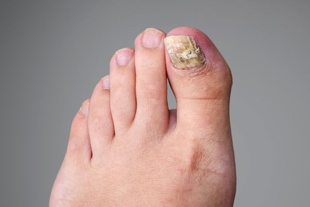 What Causes Micose De Unha? Natural Treatment