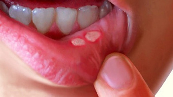 What Causes Mouth Sores? Heal With Homemade Mouthwash