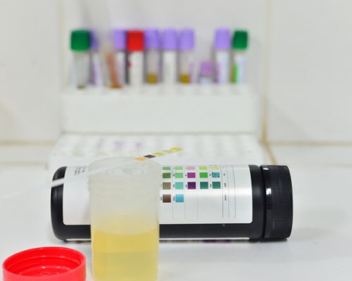 What Causes Proteinuria? Managing Symptoms