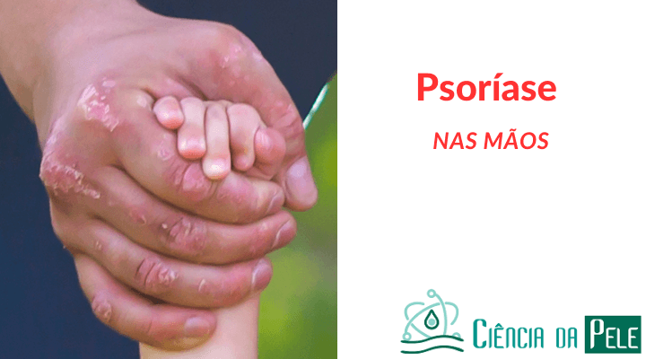 What Causes Psoríase Na Cabeça? Symptoms Relief