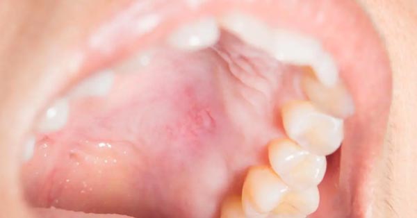 What Causes Roof Of Mouth Swell? Fast Relief Tips