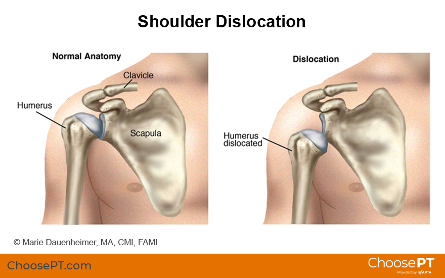 What Causes Shoulder Dislocation? Prevent Injury Now What Causes Shoulder Dislocation? Prevent Injury Now