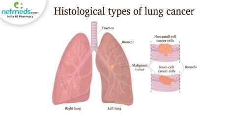 What Causes Small Cell Lung Cancer Rash? Symptoms Guide