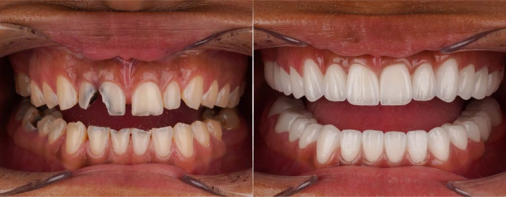 What Causes Small Chip In Front Tooth? Fix It Today