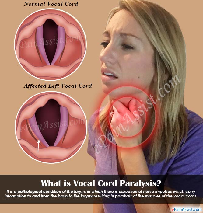 What Causes Vocal Cord Paralysis? Find Relief What Causes Vocal Cord Paralysis? Find Relief