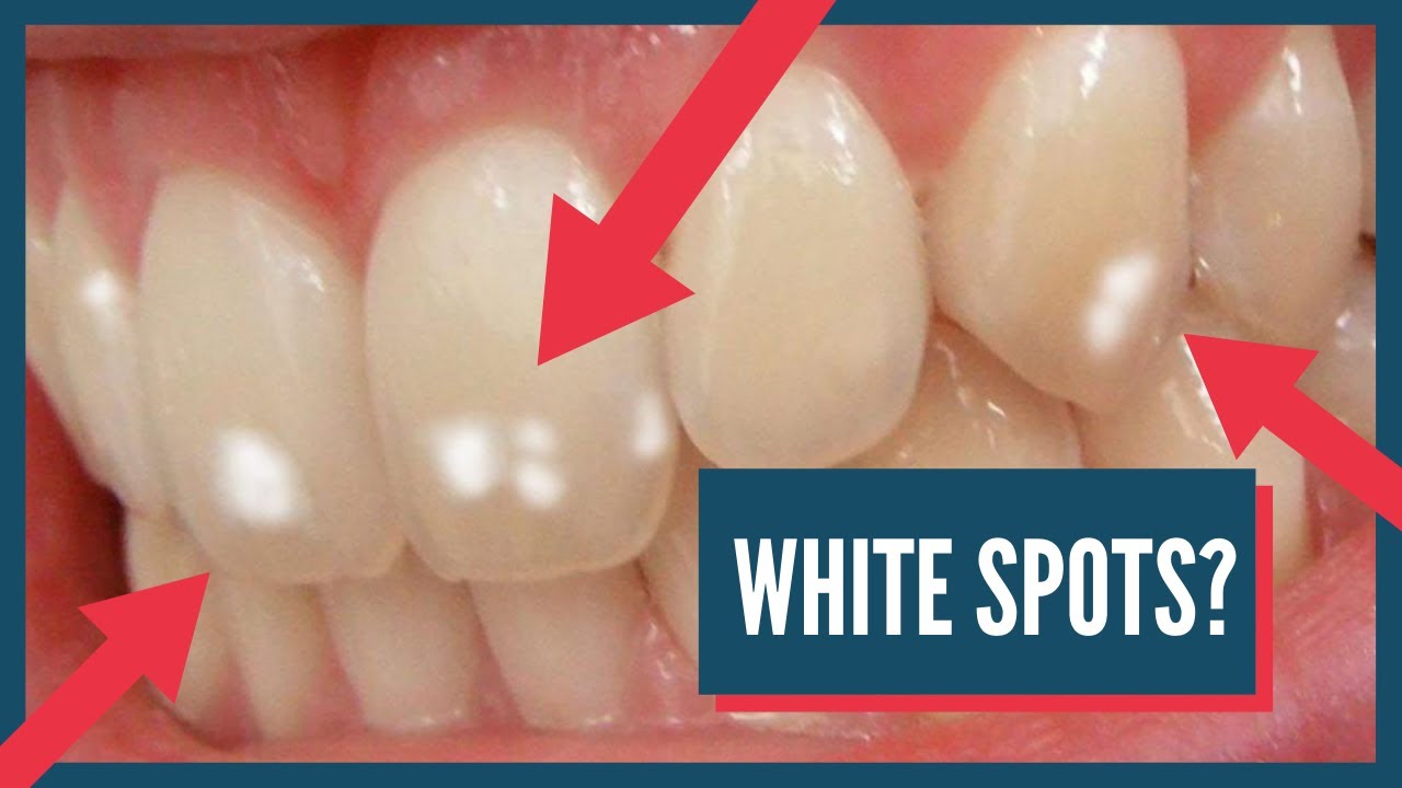 What Causes White Spots After Whitening? Fix Now