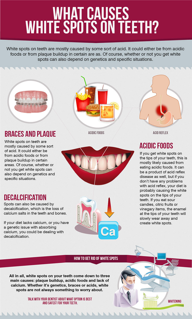 What Causes White Spots Between Teeth? Fix Now