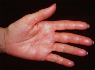 What Foods Help Herpes? Natural Relief Guide