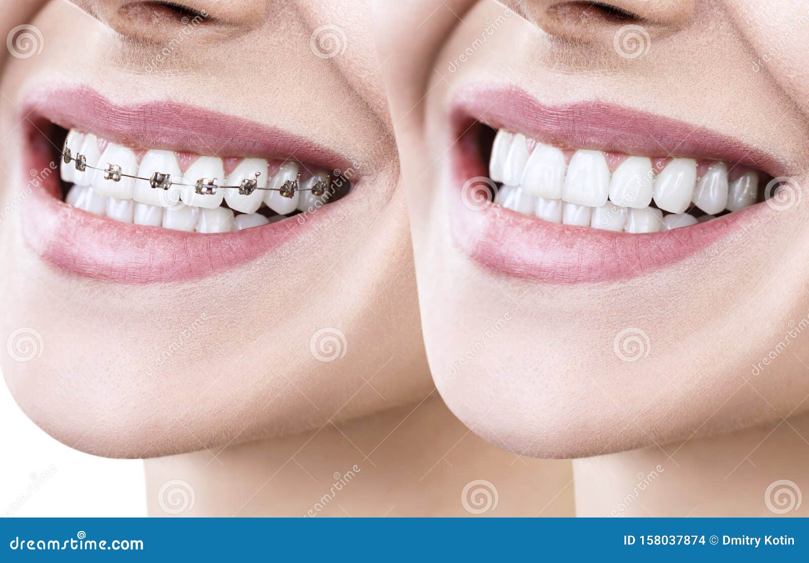 What Happens To Teeth After Braces? Perfect Smile Tips