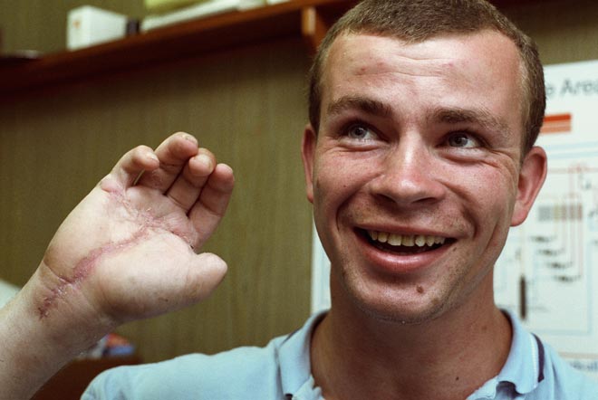 What If Fingers Can't Be Reattached? Surgical Options