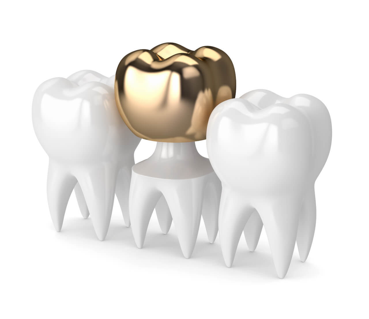 What Is A Metal Tooth Crown? Fixing Smiles