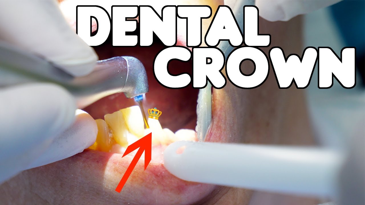 What Is A Plastic Crown Tooth? Instant Repair Solution