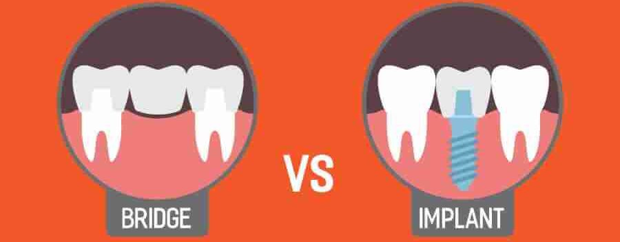What Is Better, Dental Bridge Or Implant? Comparison Guide What Is Better, Dental Bridge Or Implant? Comparison Guide
