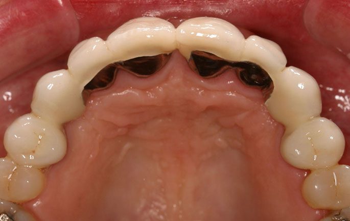 What Is Dental Bridge For 4 Front Teeth? Smile Restoration