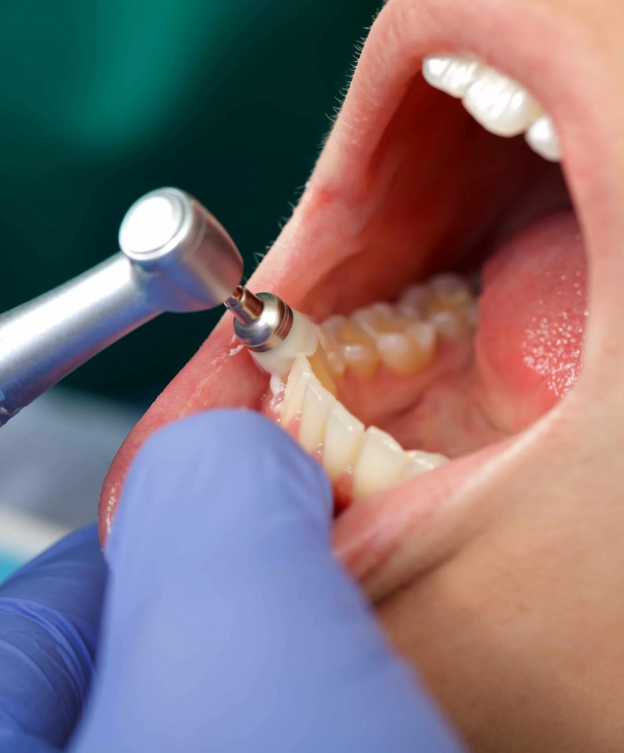 What Is Dental Prophylaxis