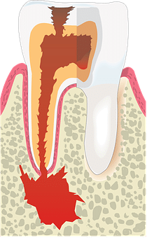 What Is Endodontics And Periodontics
