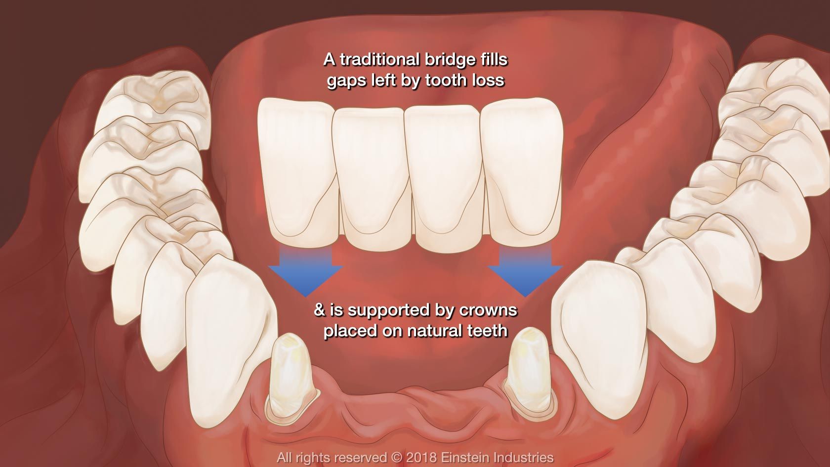 What Is Front Bridge Dental? Fix Your Smile Today
