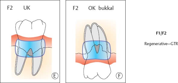 What Is Furcation In Dentistry What Is Furcation In Dentistry