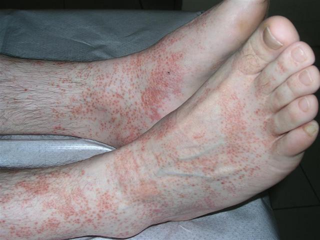 What Is Lichenoid Dermatitis
