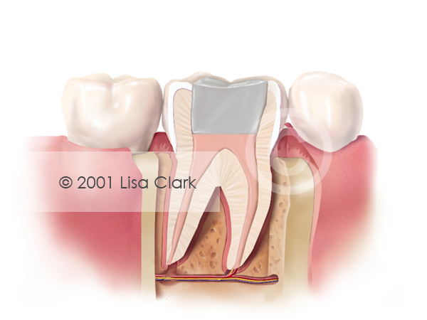What Is Root Canal Filling Material? Best Options What Is Root Canal Filling Material? Best Options