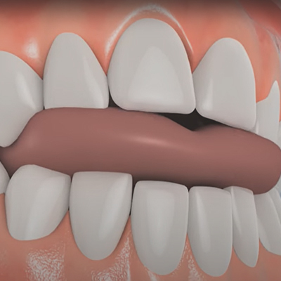 What Is Shave Teeth Down? Fixing Uneven Bite
