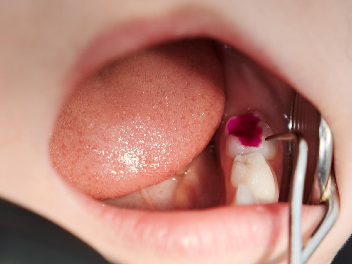 What Is Small Cavity Filling? A Painless Solution What Is Small Cavity Filling? A Painless Solution
