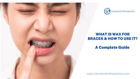 What Is Wax For Braces? Relief Guide