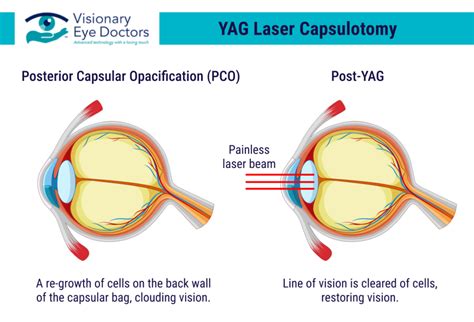 What Is Yag Eye Laser? Safe Vision Correction