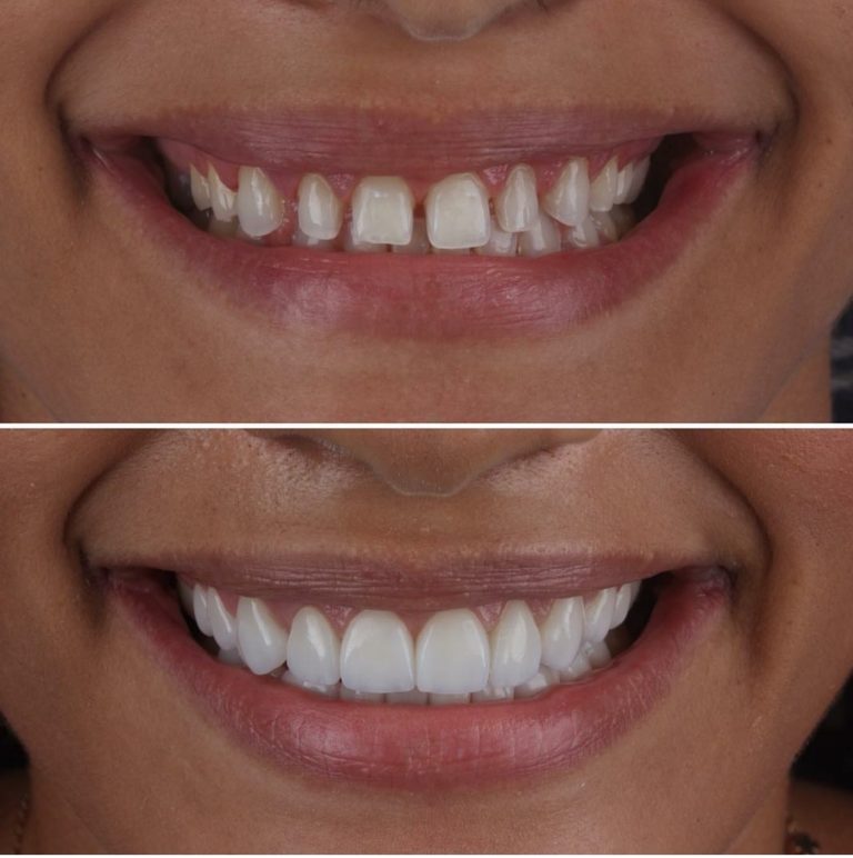 What Services Does Aspen Dental Forsyth Offer? Expert Care