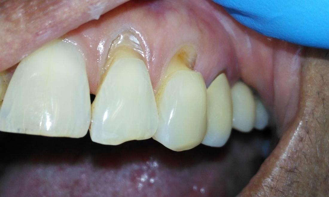 What To Do After Filling