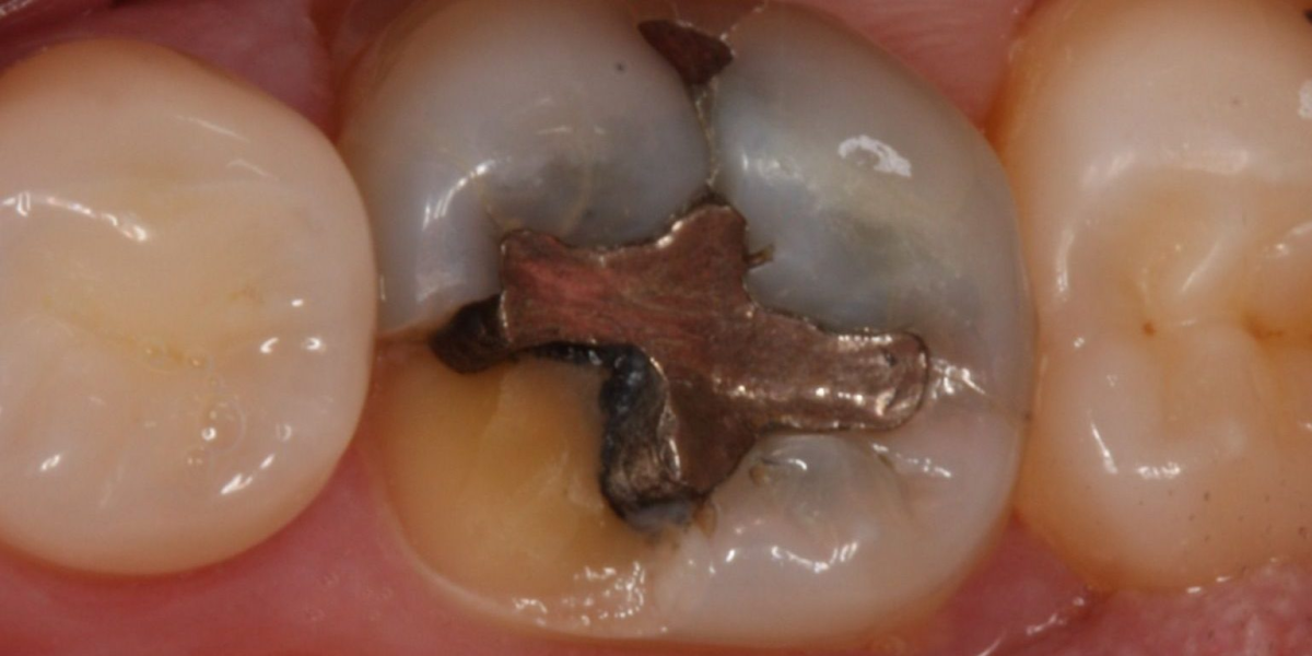 What To Do After Fillings